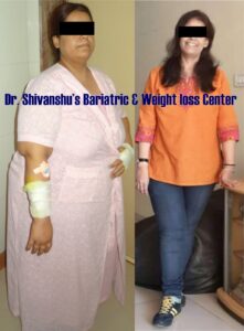 Patient before and after weight loss surgery