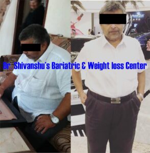 Patient before and after weight loss surgery