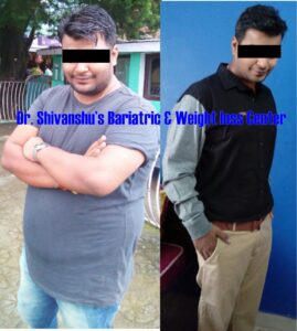 Patient before and after weight loss surgery