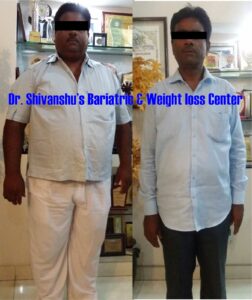 Patient before and after weight loss surgery
