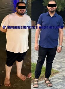 Patient before and after weight loss surgery