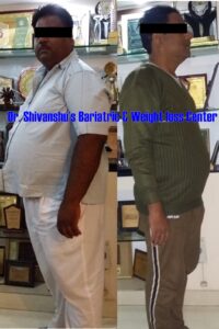 Patient before and after weight loss surgery