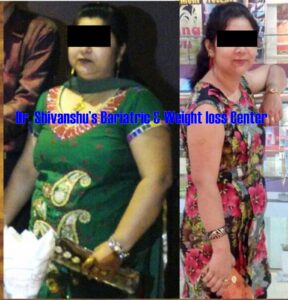 Patient before and after weight loss surgery